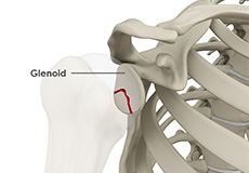 Glenoid Fractures